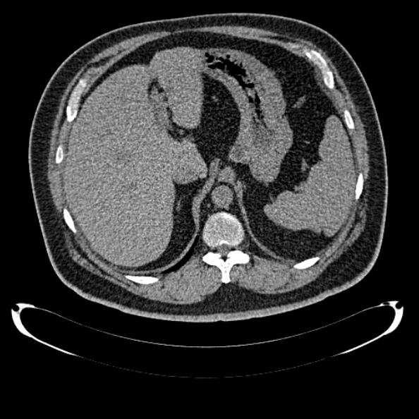 File:Bosniak renal cyst - type IV (Radiopaedia 24244-24518 Axial non-contrast 95).jpg