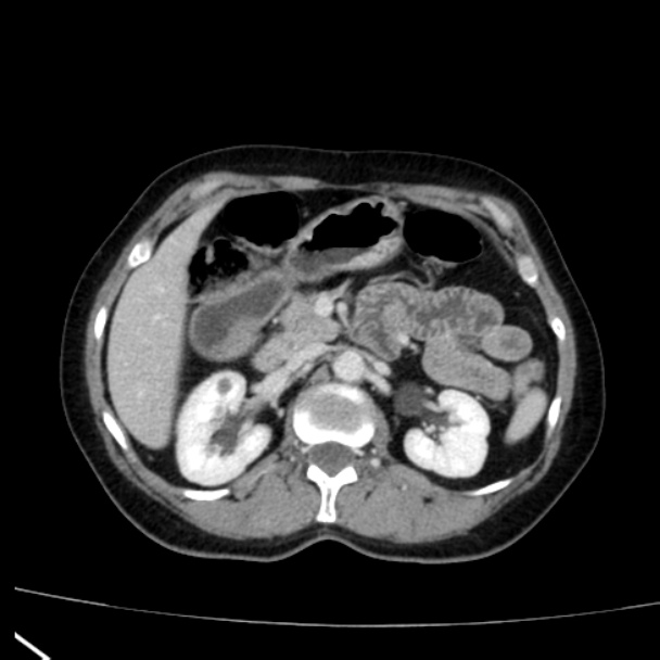 Bosniak renal cyst - type I (Radiopaedia 27479-27675 C 30).jpg