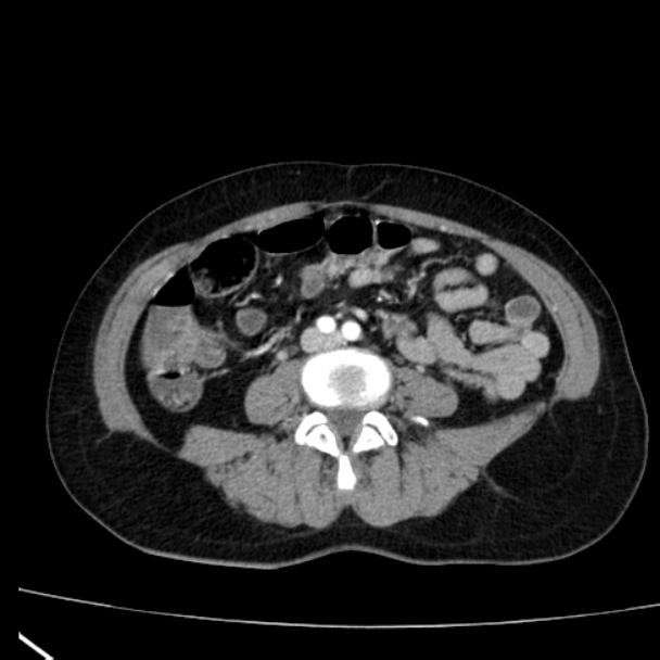 Bosniak renal cyst - type I (Radiopaedia 27479-27675 renal cortical phase 55).jpg