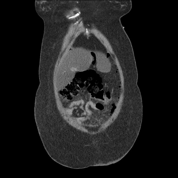 Bowel and splenic infarcts in acute lymphocytic leukemia (Radiopaedia 61055-68915 B 12).jpg