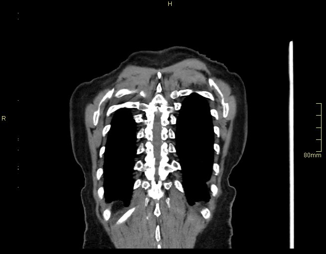 Brachial artery foreign body (Radiopaedia 54583-60820 Coronal non-contrast 54).jpg