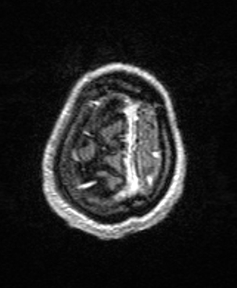 Brain abscess with dual rim sign (Radiopaedia 87566-103938 Axial T1 C+ 146).jpg