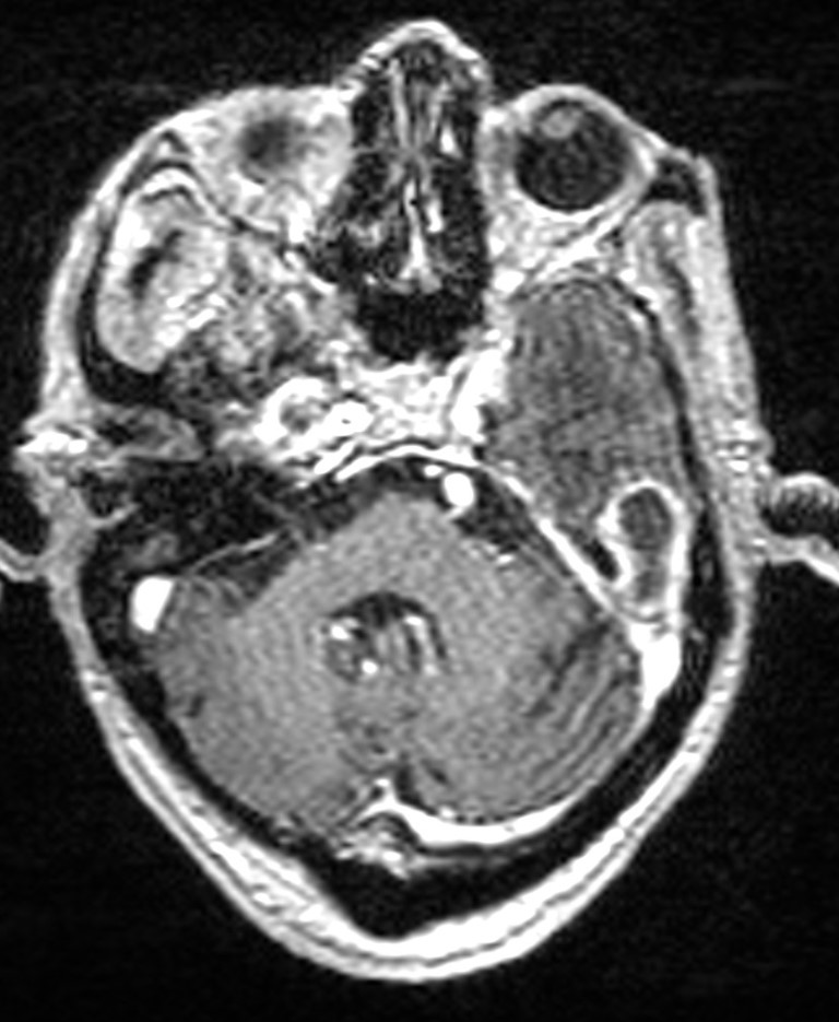Brain abscess with dual rim sign (Radiopaedia 87566-103938 Axial T1 C+ 46).jpg