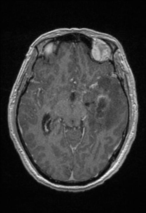 Brain abscess with ventriculitis (Radiopaedia 85703-101495 Axial T1 C+ 79).jpg