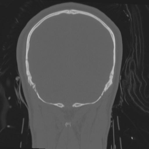 Brain contusions, internal carotid artery dissection and base of skull fracture (Radiopaedia 34089-35339 Coronal bone window 54).png