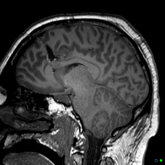Brain death on MRI and CT angiography (Radiopaedia 42560-45689 Sagittal T1 33).jpg