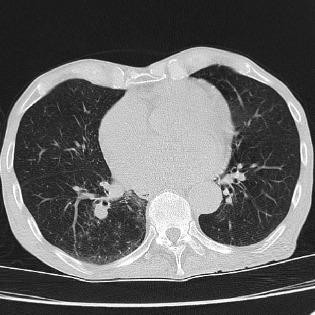 Brain metastases from lung cancer (Radiopaedia 27849-28093 Axial lung window 42).jpg
