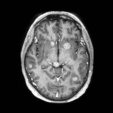 Brain metastases from lung cancer (Radiopaedia 83839-99028 Axial T1 C+ 28).jpg