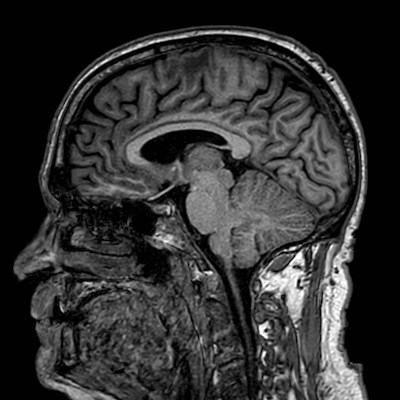 Brain metastases from lung cancer (Radiopaedia 83839-99028 Sagittal T1 69).jpg