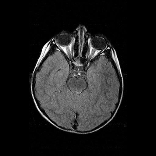 File:Brainstem ganglioglioma (Radiopaedia 10763-11224 Axial FLAIR 13).jpg