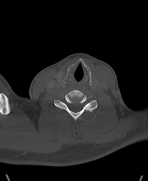 Branchial cleft cyst (Radiopaedia 31167-31875 Axial bone window 50).jpg