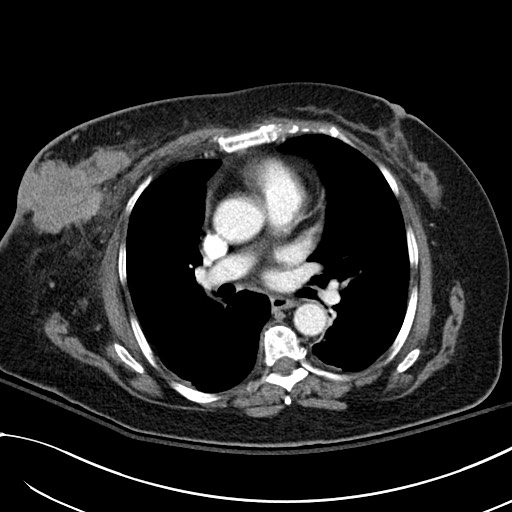 File:Breast carcinoma with pathological hip fracture (Radiopaedia 60314-67974 A 27).jpg