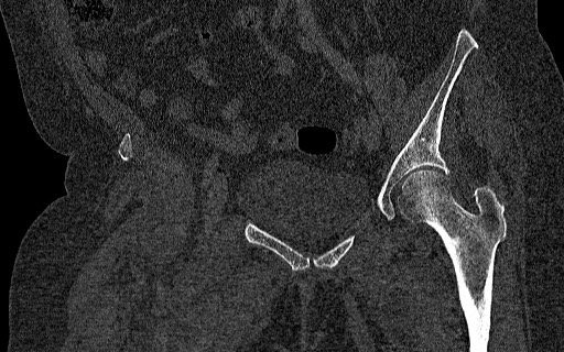 File:Breast carcinoma with pathological hip fracture (Radiopaedia 60314-67993 Coronal bone window 62).jpg