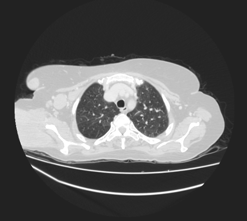 Breast metastases from facial malignant melanoma (Radiopaedia 60316-67975 Axial lung window 19).jpg