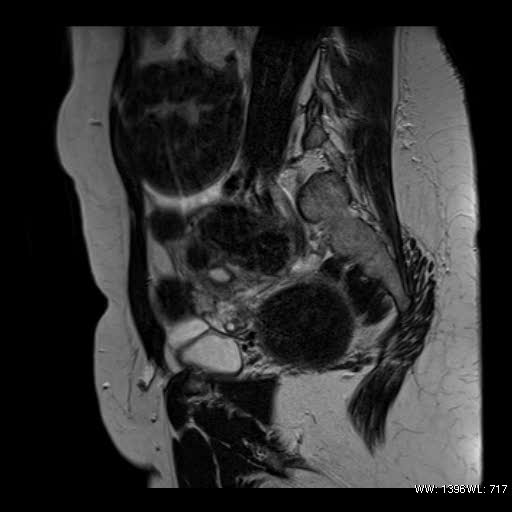 File:Broad ligament fibroid (Radiopaedia 49135-54241 Sagittal T2 8).jpg