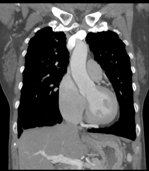 File:Bronchial artery aneurysms (Radiopaedia 42282-45385 Coronal C+ delayed 25).png