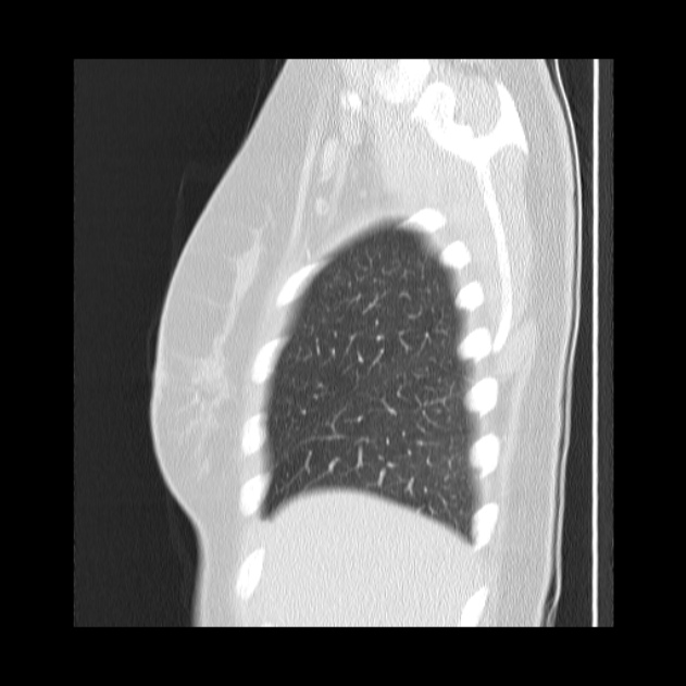 Bronchial atresia (Radiopaedia 22965-22992 Sagittal lung window 48).jpg