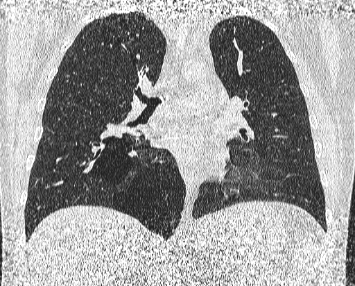 Bronchial atresia (Radiopaedia 58271-65417 Coronal lung window 29).jpg