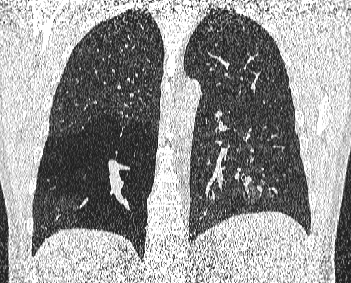 File:Bronchial atresia (Radiopaedia 58271-65417 Coronal lung window 40).jpg