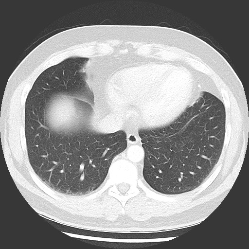 Bronchial carcinoid tumor (Radiopaedia 67377-76764 Axial lung window 46).jpg