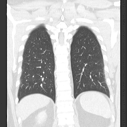 Bronchial carcinoid tumor (Radiopaedia 67377-76764 Coronal lung window 50).jpg