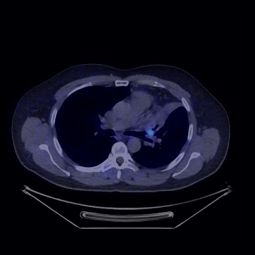Bronchial carcinoid tumor (Radiopaedia 67377-76765 68Ga-DOTATATE PET-CT 30).jpg