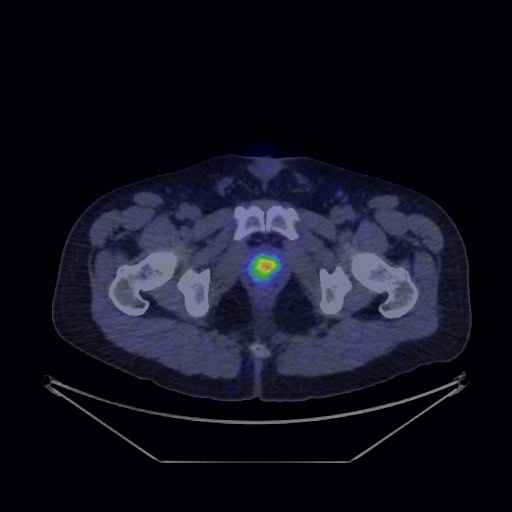 Bronchial carcinoid tumor (Radiopaedia 67377-76765 68Ga-DOTATATE PET-CT 74).jpg