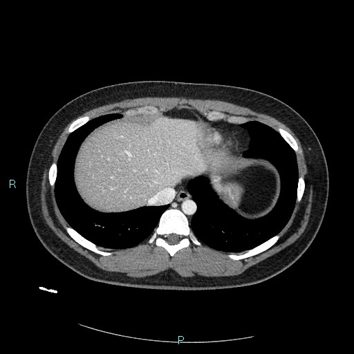 Bronchial carcinoid tumor (Radiopaedia 78272-90875 A 78).jpg