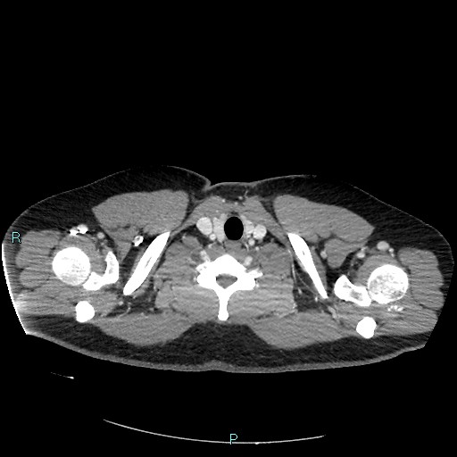 Bronchial carcinoid tumor (Radiopaedia 78272-90875 A 9).jpg