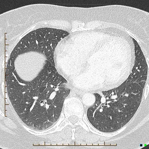 File:Bronchial diverticula (Radiopaedia 79512-92676 Axial lung window 131).jpg