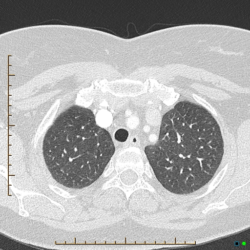 File:Bronchial diverticula (Radiopaedia 79512-92676 Axial lung window 27).jpg