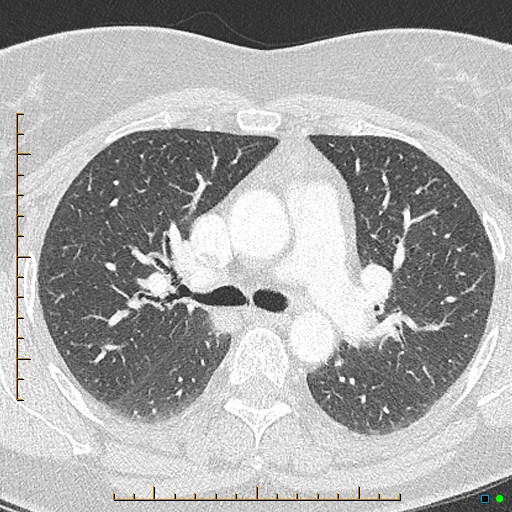 Bronchial diverticula (Radiopaedia 79512-92676 Axial lung window 72).jpg