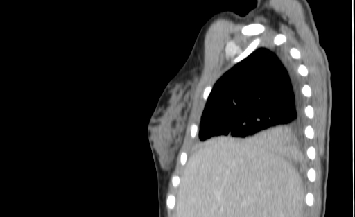 Bronchial mucoepidermoid carcinoma (Radiopaedia 57023-63895 Sagittal 23).jpg