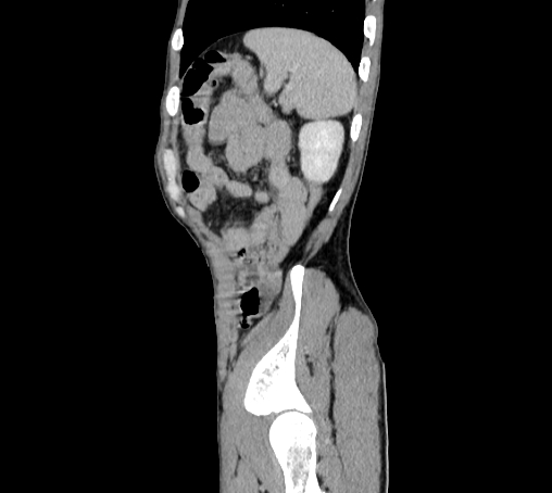 Bronchiectasis in Crohn disease (Radiopaedia 60311-67977 D 102).jpg