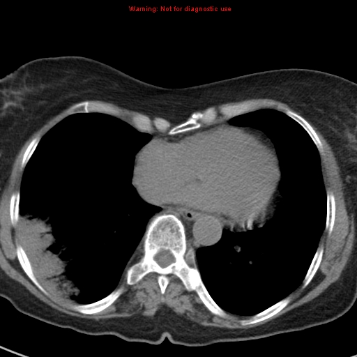 File:Bronchoalveolar carcinoma (BAC) (Radiopaedia 13436-13392 Axial non-contrast 35).jpg
