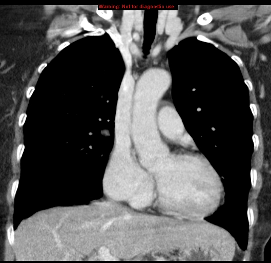 Bronchoalveolar carcinoma (BAC) (Radiopaedia 13436-13392 E 23).jpg