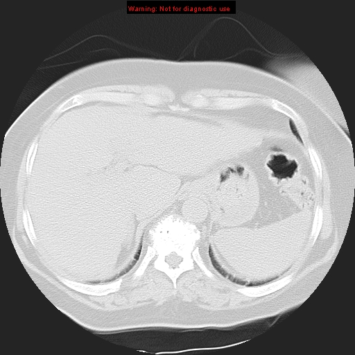 Bronchoalveolar carcinoma (Radiopaedia 13224-13233 Axial lung window 39).jpg