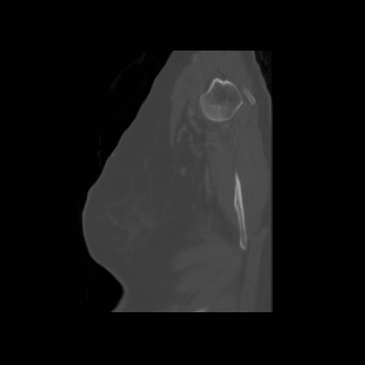 Bronchogenic carcinoma (Radiopaedia 73497-84262 Sagittal bone window 144).jpg