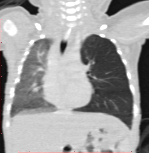 Bronchogenic cyst (Radiopaedia 78599-91409 Coronal lung window 113).jpg