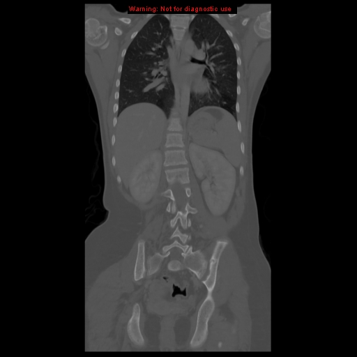 File:Brown tumor (Radiopaedia 12318-12596 D 43).jpg