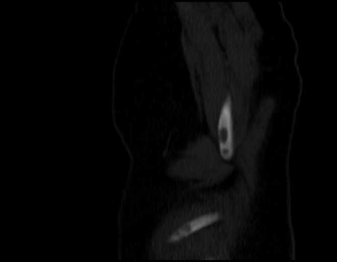 Brown tumors compressing the spinal cord (Radiopaedia 68442-77988 Sagittal bone window 56).jpg