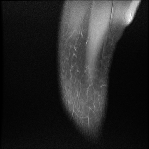 File:Bucket-handle meniscus tear (Radiopaedia 65700-74809 Sagittal PD fat sat 1).jpg