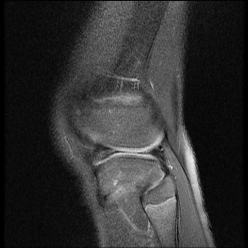 File:Bucket handle tear - lateral meniscus (Radiopaedia 72124-82634 Sagittal PD fat sat 2).jpg