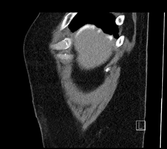Buried bumper syndrome - gastrostomy tube (Radiopaedia 63843-72577 Sagittal Inject 111).jpg