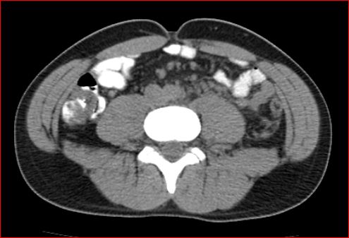 File:Burned-out testicular choriocarcinoma (Radiopaedia 32822-34040 Axial non-contrast 17).jpg
