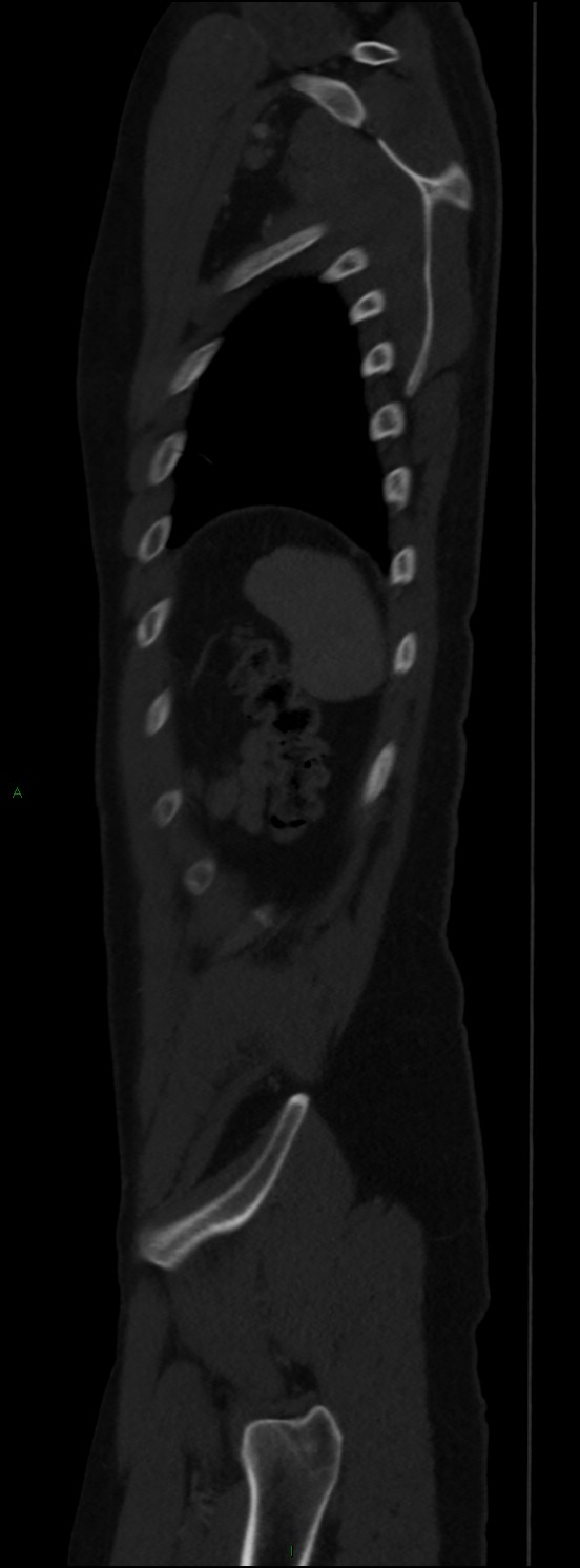 Burst fracture (Radiopaedia 83168-97542 Sagittal bone window 105).jpg