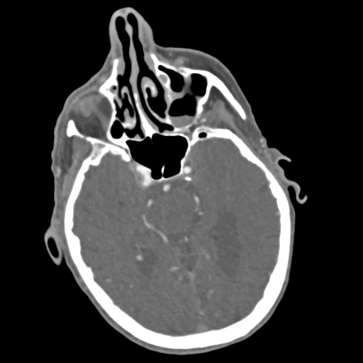 C2 fracture with vertebral artery dissection (Radiopaedia 37378-39200 A 229).png