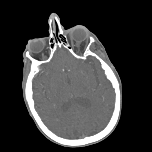 File:C2 fracture with vertebral artery dissection (Radiopaedia 37378-39200 A 247).png