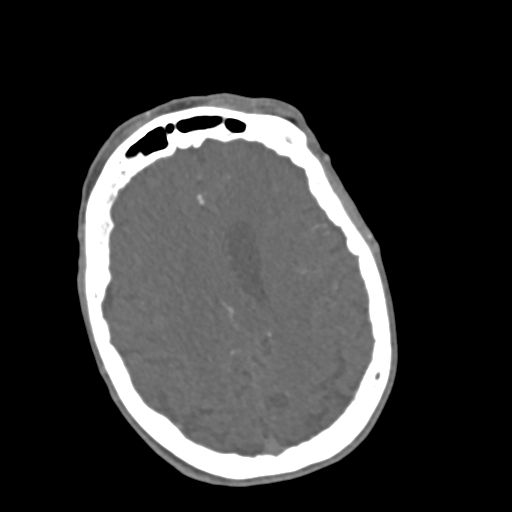 File:C2 fracture with vertebral artery dissection (Radiopaedia 37378-39200 A 270).png