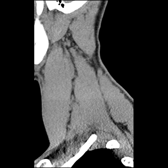 C5 facet fracture (Radiopaedia 58374-65499 D 61).jpg